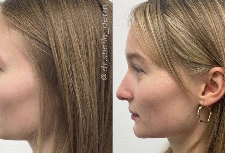Everything You Need to Know About Facial Balancing